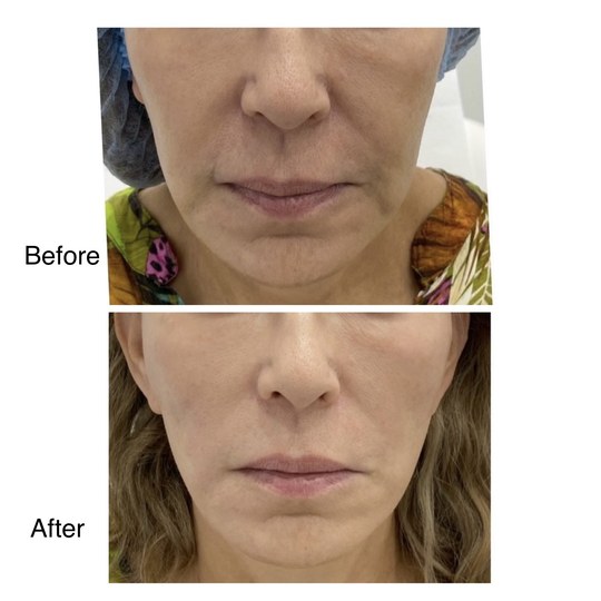 Before and after thread lifting, supplied by Dr. Zaheer Abbas