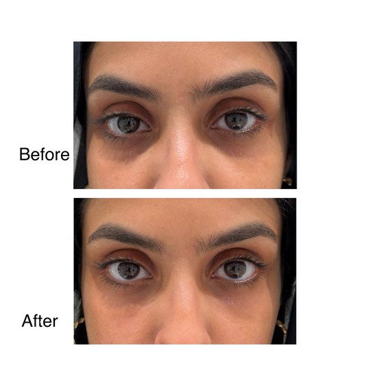 Before and after under-eye filler, supplied by Dr. Zaheer Abbas
