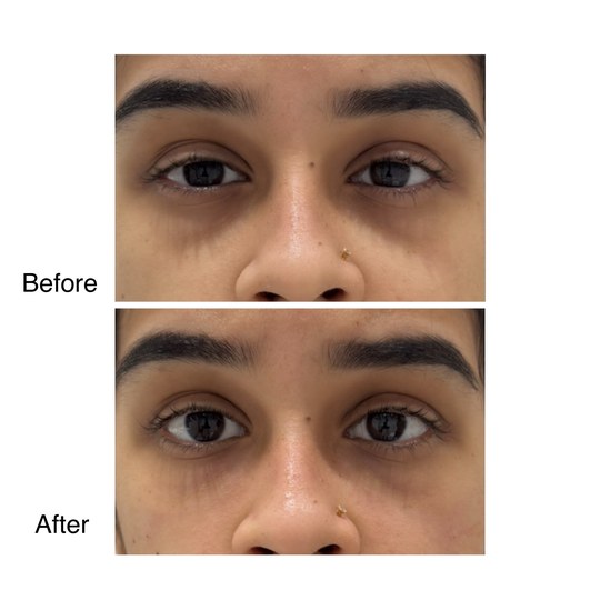 Before and after under-eye filler, supplied by Dr. Zaheer Abbas