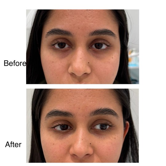 Before and after under-eye filler, supplied by Dr. Zaheer Abbas